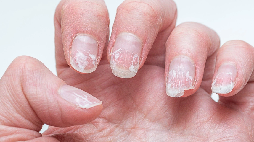 How To Repair A Broken Nail At Home Simple Steps 10 Frequently Splitting Your Nails? Here's the Reason and Solution