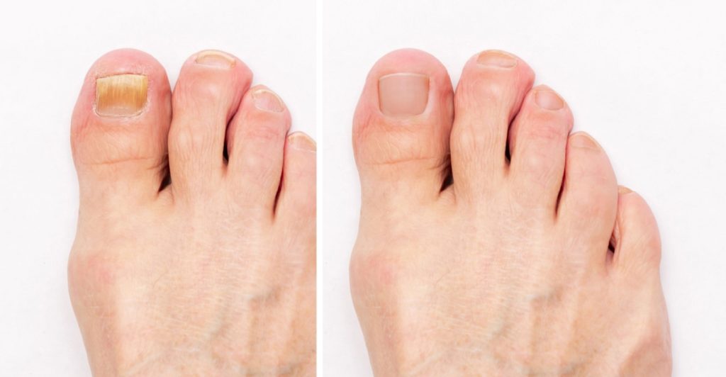 Pro Nail Care For Athletes A Guide To Healthy Nails 11 Get Healthy, Beautiful Nails for Summer – Say Goodbye to Yellow Toenail Fungus