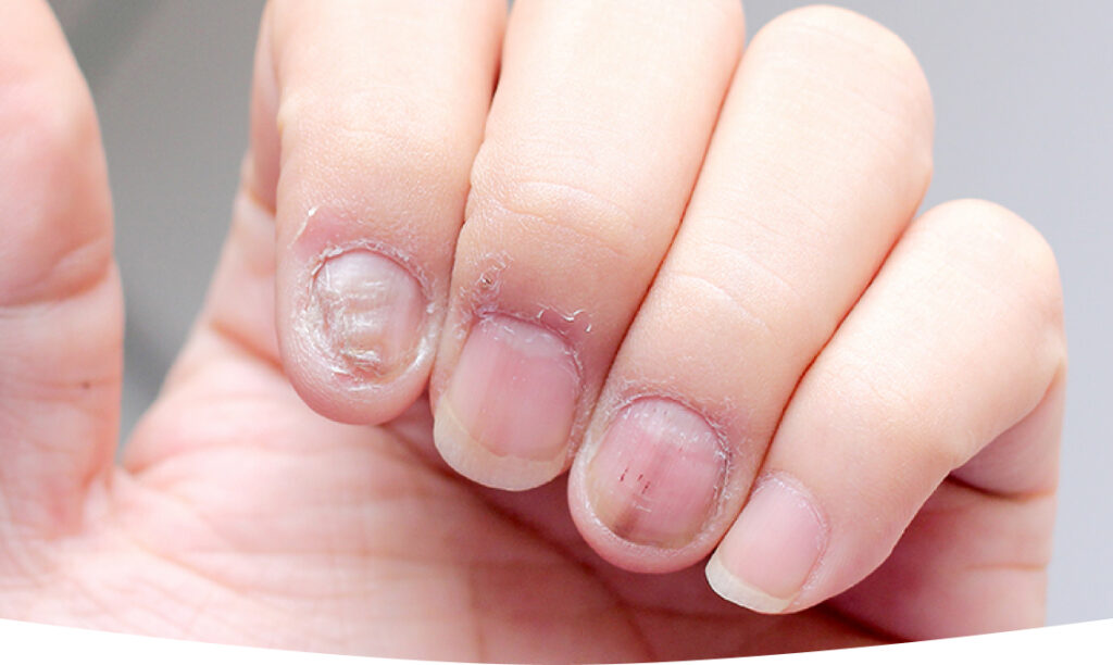 8 Common Nail Fungus Signs A Guide From Experts 7 Understanding Fungal Nail Infections: Symptoms, Diagnosis, and Prevention - Dermatologist Singapore | Skin Specialist Clinic | RDSC