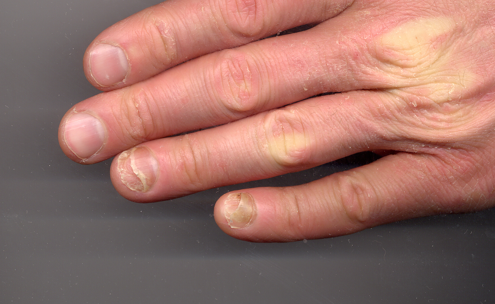 8 Common Nail Fungus Signs A Guide From Experts 9 Onycholysis - Wikipedia
