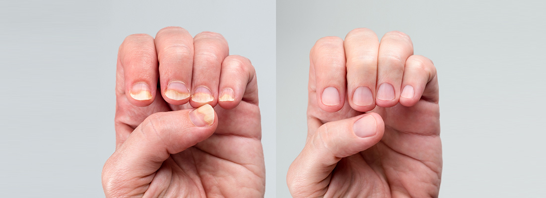 8 Common Nail Fungus Signs A Guide From Experts 11 Nail Psoriasis vs. Fungus: Differences & Clinical Treatment Options