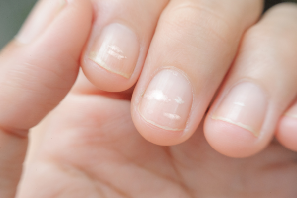 What Is The Cause Of White Spots On Your Nails? 6 Blog - Nail disease - Silcare®