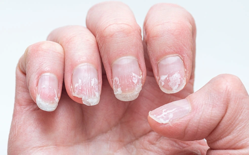 Why Are My Nails Peeling? 8 Common Causes and Fixes 7 How to Get Rid of Peeling Nails: Tips and Remedies for Healthy Nails